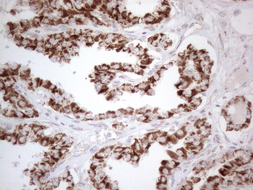 BP1 / DLX4 Antibody - Immunohistochemical staining of paraffin-embedded Carcinoma of Human thyroid tissue using anti-DLX4 mouse monoclonal antibody. (Heat-induced epitope retrieval by 1mM EDTA in 10mM Tris buffer. (pH8.5) at 120°C for 3 min. (1:150)