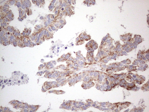 BP1 / DLX4 Antibody - Immunohistochemical staining of paraffin-embedded Adenocarcinoma of Human ovary tissue using anti-DLX4 mouse monoclonal antibody. (Heat-induced epitope retrieval by 1mM EDTA in 10mM Tris buffer. (pH8.5) at 120°C for 3 min. (1:150)
