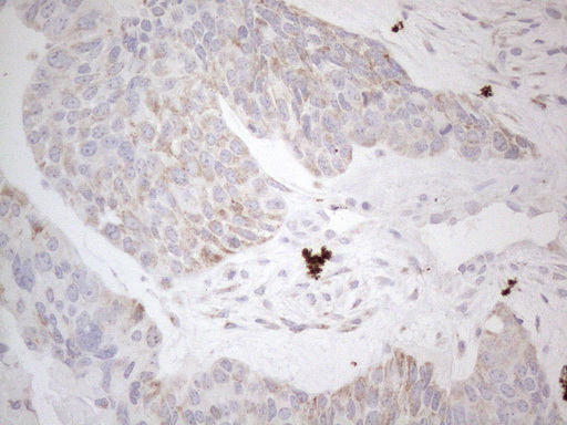BP1 / DLX4 Antibody - Immunohistochemical staining of paraffin-embedded Adenocarcinoma of Human endometrium tissue using anti-DLX4 mouse monoclonal antibody. (Heat-induced epitope retrieval by 1mM EDTA in 10mM Tris buffer. (pH8.5) at 120°C for 3 min. (1:150)
