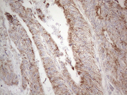 BP1 / DLX4 Antibody - Immunohistochemical staining of paraffin-embedded Adenocarcinoma of Human colon tissue using anti-DLX4 mouse monoclonal antibody. (Heat-induced epitope retrieval by 1mM EDTA in 10mM Tris buffer. (pH8.5) at 120°C for 3 min. (1:150)