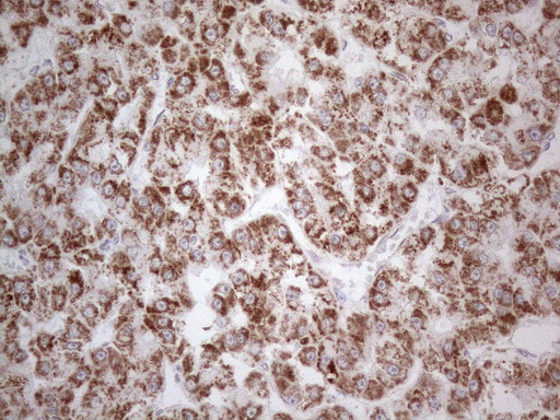 BP1 / DLX4 Antibody - Immunohistochemical staining of paraffin-embedded Carcinoma of Human liver tissue using anti-DLX4 mouse monoclonal antibody. (Heat-induced epitope retrieval by 1mM EDTA in 10mM Tris buffer. (pH8.5) at 120°C for 3 min. (1:150)