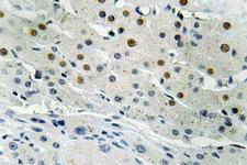 BP1 / DLX4 Antibody - IHC of Dlx-4 (Q90) pAb in paraffin-embedded human liver carcinoma tissue.