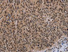 BP1 / DLX4 Antibody - Immunohistochemistry of paraffin-embedded Human thyroid cancer using DLX4 Polyclonal Antibody at dilution of 1:50.