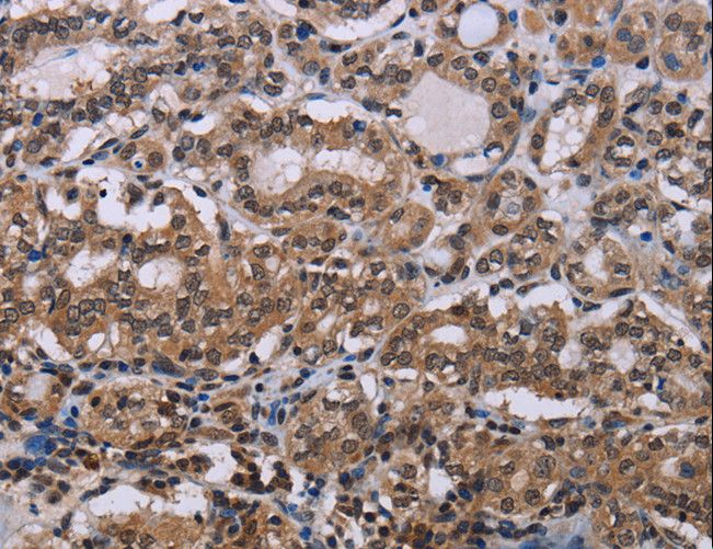 BP1 / DLX4 Antibody - Immunohistochemistry of paraffin-embedded Human thyroid cancer using DLX4 Polyclonal Antibody at dilution of 1:50.