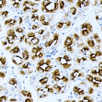 BPGM Antibody - Immunohistochemical analysis of BPGM staining in human gastric cancer formalin fixed paraffin embedded tissue section. The section was pre-treated using heat mediated antigen retrieval with sodium citrate buffer (pH 6.0). The section was then incubated with the antibody at room temperature and detected using an HRP conjugated compact polymer system. DAB was used as the chromogen. The section was then counterstained with hematoxylin and mounted with DPX.