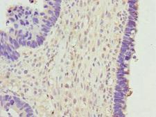 BPGM Antibody - Immunohistochemistry of paraffin-embedded human ovarian cancer at dilution 1:100