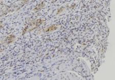 BPIFA1 / SPLUNC1 Antibody - 1:100 staining human lung carcinoma tissue by IHC-P. The sample was formaldehyde fixed and a heat mediated antigen retrieval step in citrate buffer was performed. The sample was then blocked and incubated with the antibody for 1.5 hours at 22°C. An HRP conjugated goat anti-rabbit antibody was used as the secondary.