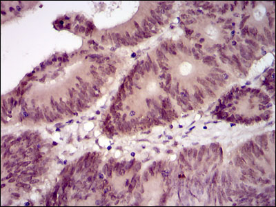 BPIFB1 Antibody - IHC of paraffin-embedded colon cancer tissues using Lplunc1 mouse monoclonal antibody with DAB staining.