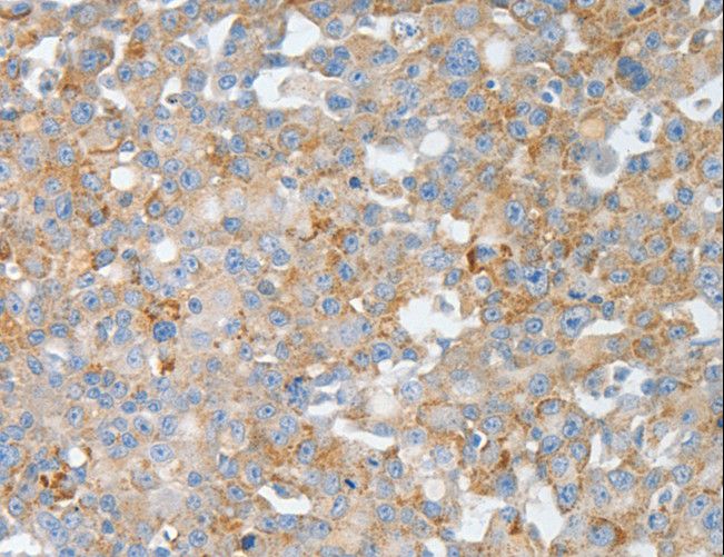 BPIFB2 Antibody - Immunohistochemistry of paraffin-embedded Human breast cancer using BPIFB2 Polyclonal Antibody at dilution of 1:50.