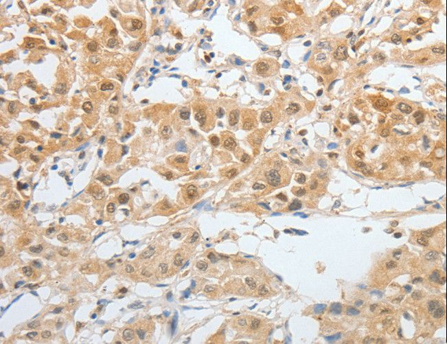 BPIFB2 Antibody - Immunohistochemistry of paraffin-embedded Human lung cancer using BPIFB2 Polyclonal Antibody at dilution of 1:45.