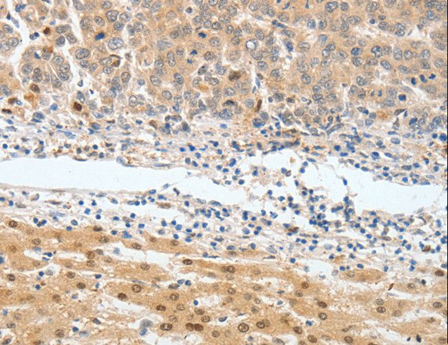 BPIFB2 Antibody - Immunohistochemistry of paraffin-embedded Human lung cancer using BPIFB2 Polyclonal Antibody at dilution of 1:45.