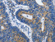 BPIFB3 / C20orf185 Antibody - Immunohistochemistry of paraffin-embedded Human colon cancer using BPIFB3 Polyclonal Antibody at dilution of 1:50.