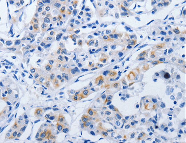 BPIFB3 / C20orf185 Antibody - Immunohistochemistry of paraffin-embedded Human lung cancer using BPIFB3 Polyclonal Antibody at dilution of 1:50.