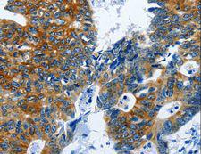 BPIFB3 / C20orf185 Antibody - Immunohistochemistry of paraffin-embedded Human colon cancer using BPIFB3 Polyclonal Antibody at dilution of 1:120.