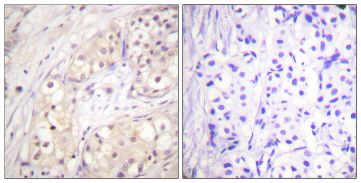 BRAF / B-Raf Antibody - Immunohistochemistry analysis of paraffin-embedded human breast carcinoma tissue, using B-RAF Antibody. The picture on the right is blocked with the synthesized peptide.