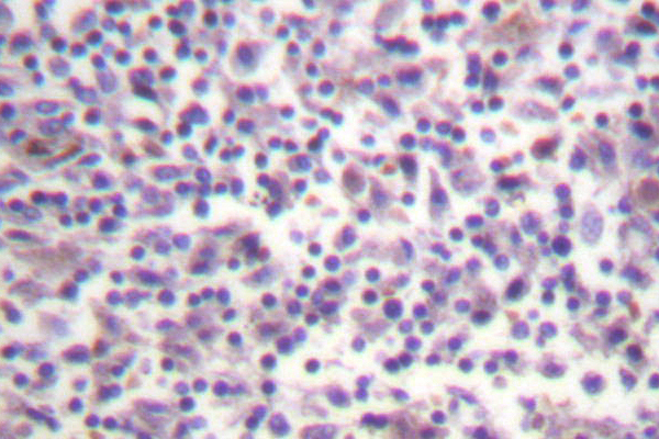 BRAF / B-Raf Antibody - IHC of B-Raf (A597) pAb in paraffin-embedded human breast carcinoma tissue.
