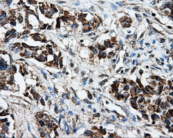 BRAF / B-Raf Antibody - Immunohistochemical staining of paraffin-embedded Adenocarcinoma of breast tissue using anti-BRAF mouse monoclonal antibody. (Dilution 1:50).