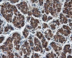 BRAF / B-Raf Antibody - Immunohistochemical staining of paraffin-embedded Carcinoma of liver tissue using anti-BRAF mouse monoclonal antibody. (Dilution 1:50).