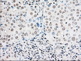 BRAF / B-Raf Antibody - IHC of paraffin-embedded Adenocarcinoma of breast tissue using anti-BRAF mouse monoclonal antibody. (Dilution 1:50).