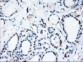 BRAF / B-Raf Antibody - IHC of paraffin-embedded thyroid tissue using anti-BRAF mouse monoclonal antibody. (Dilution 1:50).