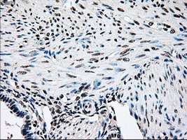 BRAF / B-Raf Antibody - Immunohistochemical staining of paraffin-embedded endometrium tissue using anti-BRAF mouse monoclonal antibody. (Dilution 1:50).