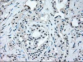BRAF / B-Raf Antibody - IHC of paraffin-embedded Carcinoma of prostate tissue using anti-BRAF mouse monoclonal antibody. (Dilution 1:50).