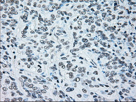 BRAF / B-Raf Antibody - IHC of paraffin-embedded Carcinoma of bladder tissue using anti-BRAF mouse monoclonal antibody. (Dilution 1:50).