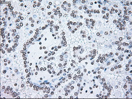 BRAF / B-Raf Antibody - IHC of paraffin-embedded Carcinoma of kidney tissue using anti-BRAF mouse monoclonal antibody. (Dilution 1:50).