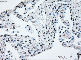 BRAF / B-Raf Antibody - IHC of paraffin-embedded Carcinoma of lung tissue using anti-BRAF mouse monoclonal antibody. (Dilution 1:50).