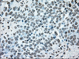 BRAF / B-Raf Antibody - IHC of paraffin-embedded Adenocarcinoma of ovary tissue using anti-BRAF mouse monoclonal antibody. (Dilution 1:50).