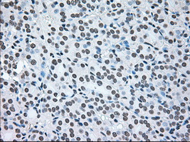 BRAF / B-Raf Antibody - IHC of paraffin-embedded Carcinoma of thyroid tissue using anti-BRAF mouse monoclonal antibody. (Dilution 1:50).