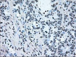 BRAF / B-Raf Antibody - IHC of paraffin-embedded Adenocarcinoma of colon tissue using anti-BRAF mouse monoclonal antibody. (Dilution 1:50).