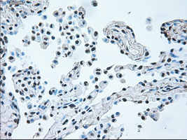 BRAF / B-Raf Antibody - IHC of paraffin-embedded Carcinoma of lung tissue using anti-BRAF mouse monoclonal antibody. (Dilution 1:50).