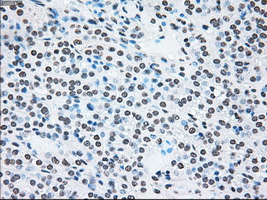 BRAF / B-Raf Antibody - IHC of paraffin-embedded Carcinoma of thyroid tissue using anti-BRAF mouse monoclonal antibody. (Dilution 1:50).