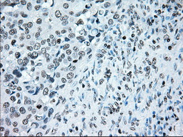 BRAF / B-Raf Antibody - IHC of paraffin-embedded Adenocarcinoma of endometrium tissue using anti-BRAF mouse monoclonal antibody. (Dilution 1:50).