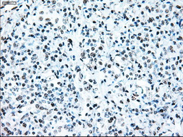 BRAF / B-Raf Antibody - IHC of paraffin-embedded lymphoma tissue using anti-BRAF mouse monoclonal antibody. (Dilution 1:50).