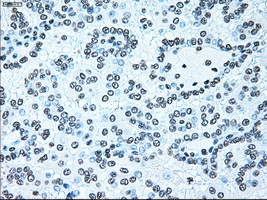 BRAF / B-Raf Antibody - IHC of paraffin-embedded Carcinoma of kidney tissue using anti-BRAF mouse monoclonal antibody. (Dilution 1:50).