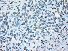 BRAF / B-Raf Antibody - IHC of paraffin-embedded Adenocarcinoma of ovary tissue using anti-BRAF mouse monoclonal antibody. (Dilution 1:50).