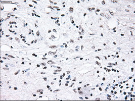 BRAF / B-Raf Antibody - IHC of paraffin-embedded Carcinoma of pancreas tissue using anti-BRAF mouse monoclonal antibody. (Dilution 1:50).