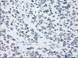 BRAF / B-Raf Antibody - IHC of paraffin-embedded Carcinoma of prostate tissue using anti-BRAF mouse monoclonal antibody. (Dilution 1:50).