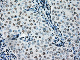 BRAF / B-Raf Antibody - IHC of paraffin-embedded Adenocarcinoma of breast tissue using anti-BRAF mouse monoclonal antibody. (Dilution 1:50).
