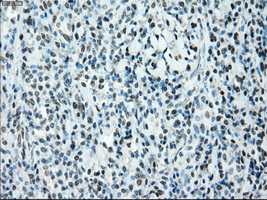 BRAF / B-Raf Antibody - IHC of paraffin-embedded lymphoma tissue using anti-BRAF mouse monoclonal antibody. (Dilution 1:50).