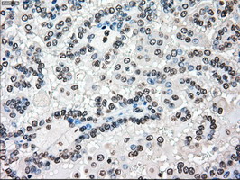 BRAF / B-Raf Antibody - IHC of paraffin-embedded Carcinoma of Human kidney tissue using anti-BRAF mouse monoclonal antibody.