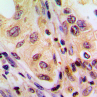 BRAF / B-Raf Antibody - Immunohistochemical analysis of B-RAF staining in human liver cancer formalin fixed paraffin embedded tissue section. The section was pre-treated using heat mediated antigen retrieval with sodium citrate buffer (pH 6.0). The section was then incubated with the antibody at room temperature and detected using an HRP conjugated compact polymer system. DAB was used as the chromogen. The section was then counterstained with hematoxylin and mounted with DPX.