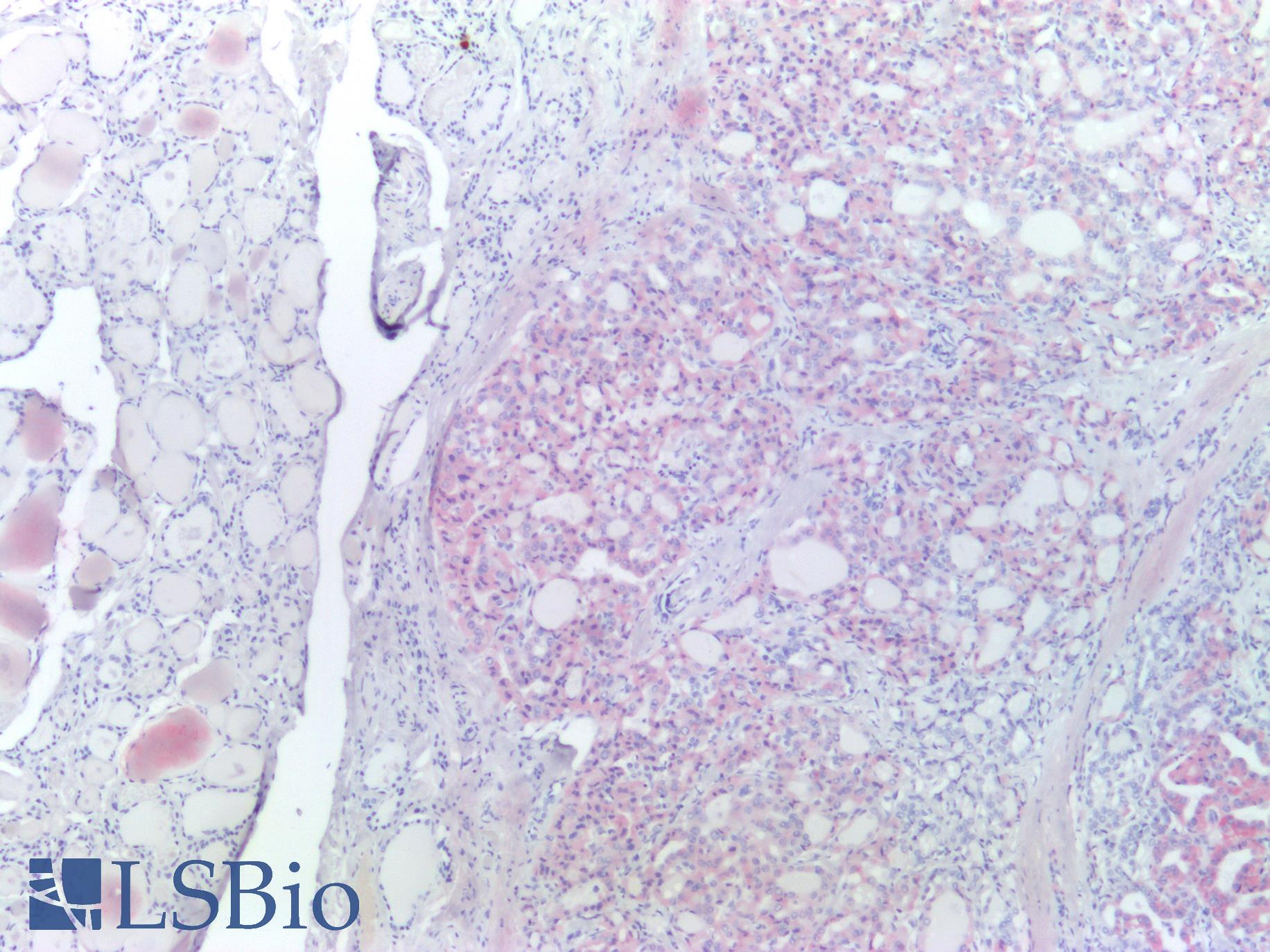 Anti-BRAF / B-Raf Antibody | Rabbit Anti-Human Ready-to-Use IHC | LSBio