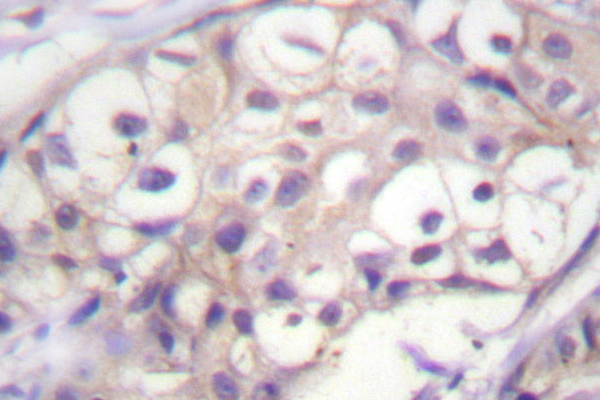 BRAF / B-Raf Antibody - IHC of B-Raf (F594) pAb in paraffin-embedded human breast carcinoma tissue.