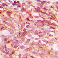 BRAF / B-Raf Antibody - Immunohistochemical analysis of B-RAF (pS446) staining in human breast cancer formalin fixed paraffin embedded tissue section. The section was pre-treated using heat mediated antigen retrieval with sodium citrate buffer (pH 6.0). The section was then incubated with the antibody at room temperature and detected with HRP and DAB as chromogen. The section was then counterstained with hematoxylin and mounted with DPX.