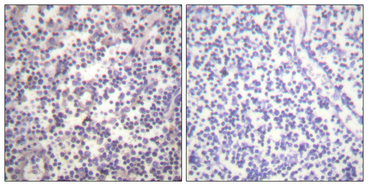 BRAF / B-Raf Antibody - Immunohistochemistry analysis of paraffin-embedded human lymph node, using B-RAF (Phospho-Ser602) Antibody. The picture on the right is blocked with the phospho peptide.
