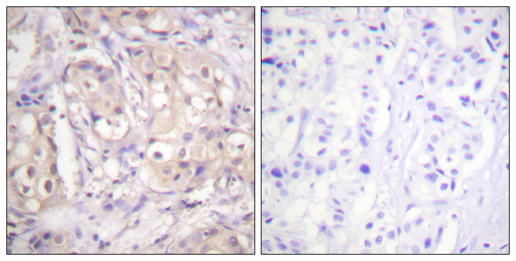 BRAF / B-Raf Antibody - Immunohistochemistry analysis of paraffin-embedded human breast carcinoma, using B-RAF (Phospho-Thr599) Antibody. The picture on the right is blocked with the phospho peptide.