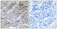 Brain Protein 44 / BRP44 Antibody - Immunohistochemistry analysis of paraffin-embedded human lung carcinoma tissue, using BRP44 Antibody. The picture on the right is blocked with the synthesized peptide.